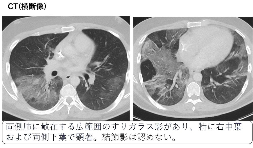 サイトメガロウイルス肺炎のCT画像診断(CMV、日和見感染、カリニ肺炎と 